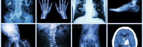 set-ray-multiple-part-human-multiple-disease-orthopedic-surgery-stroke-bone-fracture-operation-kidney-stone-48513085